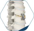 Anterior Cervical Discectomy & Fusion