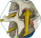 Lumbar Decompression Surgery