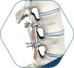Lumbar Spine MIS Fusion