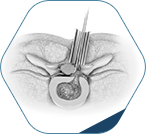 Minimally Invasive Spine Surgery