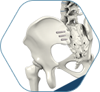 Sacroilliac Joint Fusion