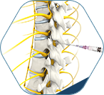 Spinal injections